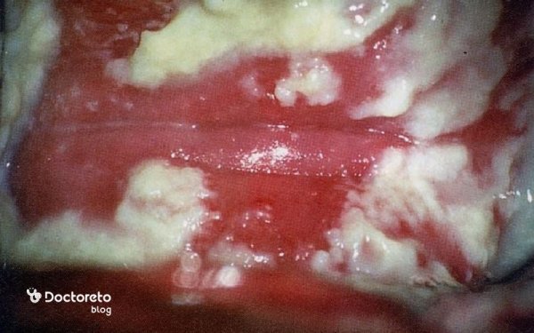 عکس انواع عفونت واژن