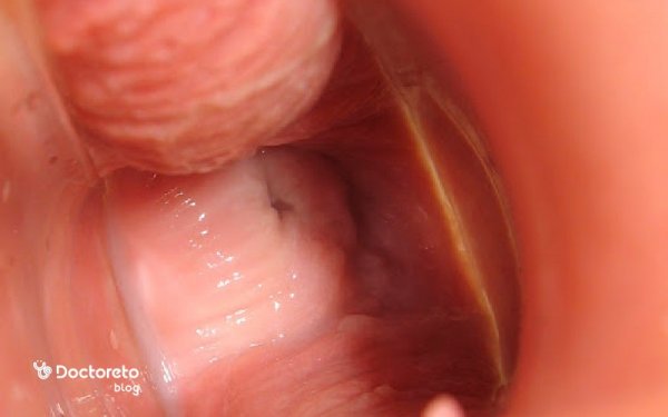 عکس واقعی عفونت قارچی واژن نی نی سایت