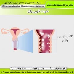  عکس واقعی عفونت قارچی واژن نی نی سایت