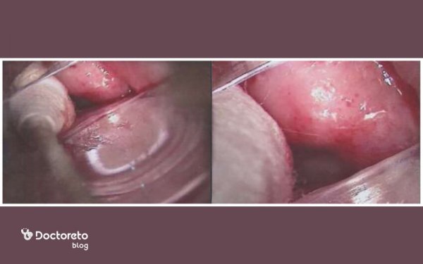  عکس واقعی عفونت قارچی واژن نی نی سایت