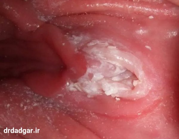  عکس واقعی عفونت قارچی واژن نی نی سایت