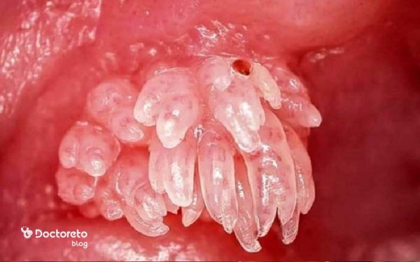  عکس واقعی عفونت قارچی واژن نی نی سایت