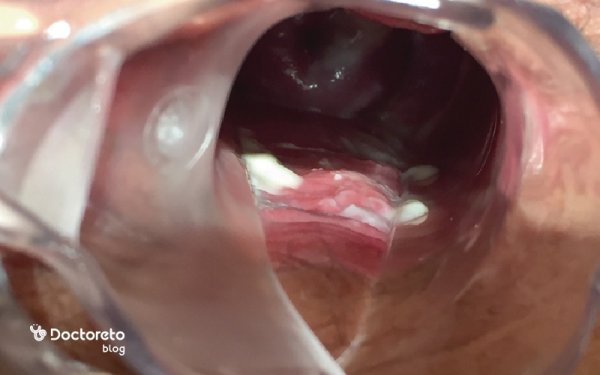  عکس واقعی عفونت قارچی واژن نی نی سایت