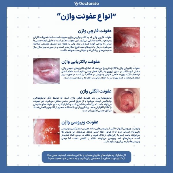  ترشحات عکس انواع عفونت واژن