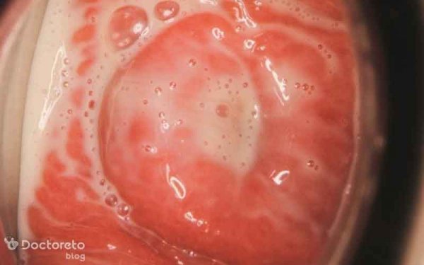  ترشحات عکس انواع عفونت واژن