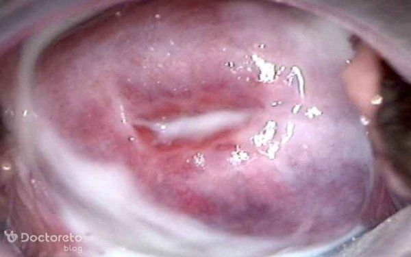  ترشحات عکس انواع عفونت واژن