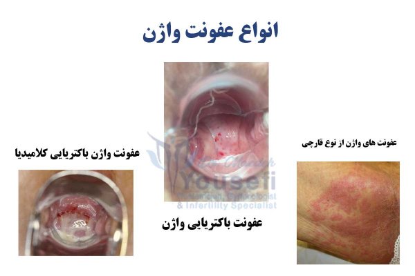  ترشحات عکس انواع عفونت واژن