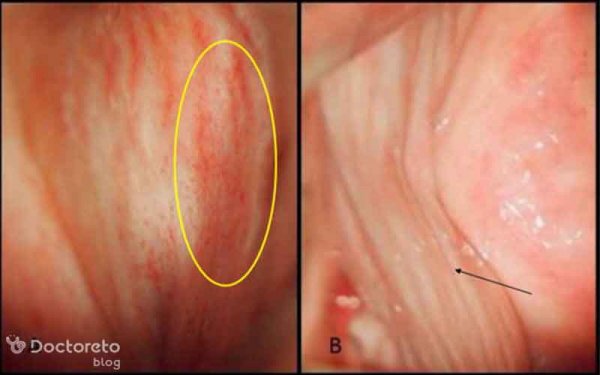  عکس عفونت مخمری واژن