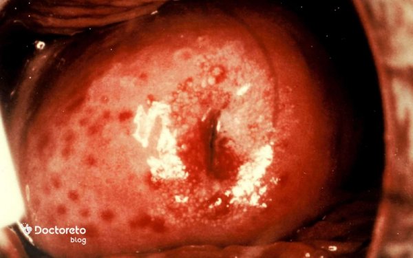  عکس عفونت واژن