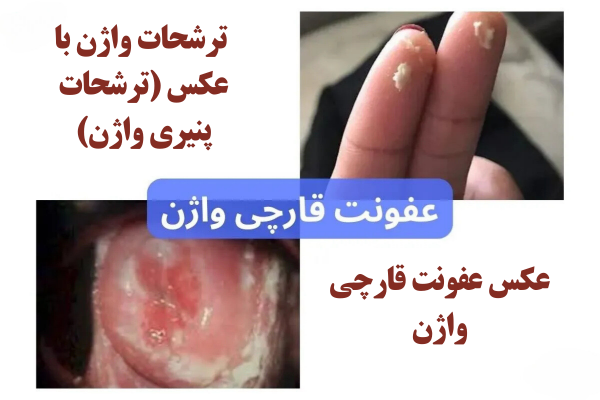  عکس عفونت واژن