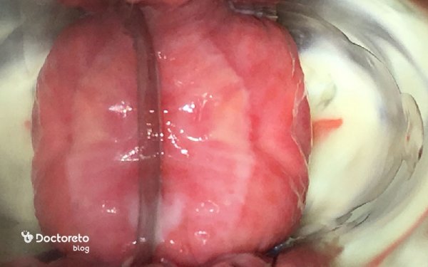  عکس عفونت واژن