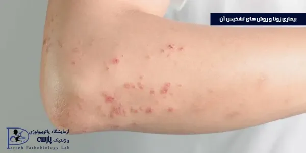 عکس بیماری زونا در بزرگسالان