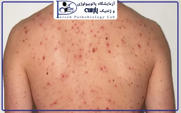  عکس بیماری زونا در بزرگسالان