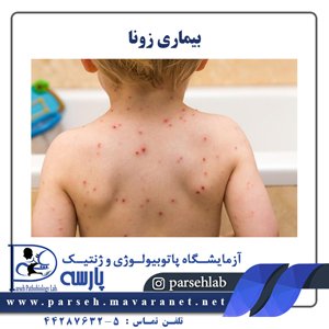  عکس بیماری زونا در بزرگسالان