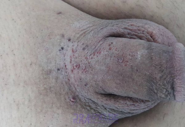  عکس زگیل تناسلی در مردان