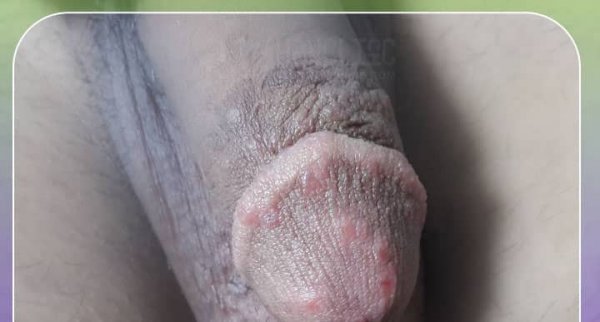  عکس زگیل تناسلی نوع ۱۶