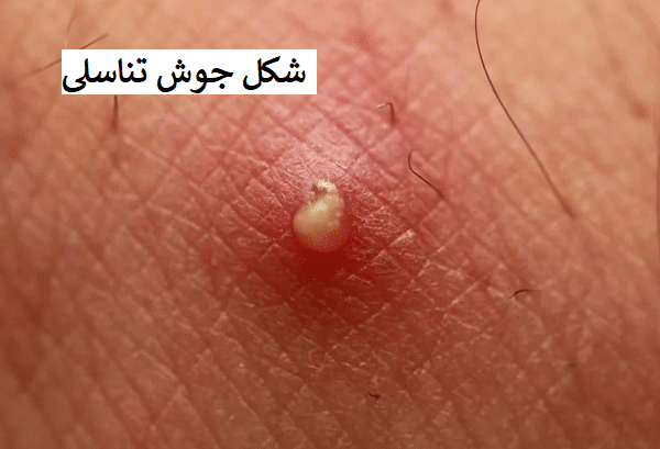  عکس زگیل تناسلی نوع ۱۶