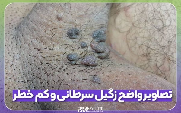  عکس زگیل تناسلی نوع ۱۶