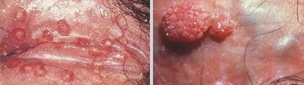  عکس زگیل تناسلی کم خطر در مردان