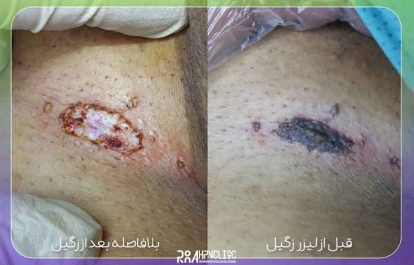  عکس زگیل تناسلی کم خطر در مردان