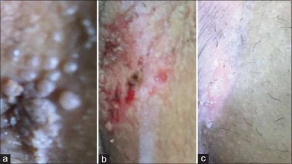  عکس زگیل تناسلی کم خطر در مردان