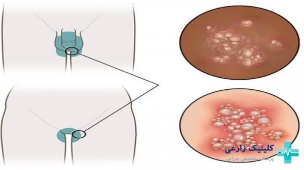  عکس واضح از زگیل تناسلی زنان نی نی سایت