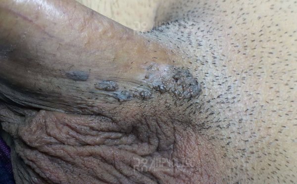  عکس واضح از زگیل تناسلی زنان نی نی سایت