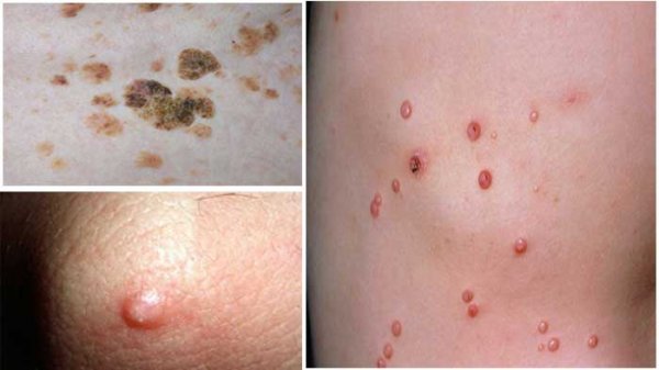  عکس واضح از زگیل تناسلی زنان نی نی سایت