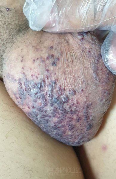  عکس واضح از زگیل تناسلی زنان نی نی سایت