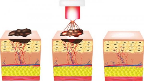عکس زگیل تناسلی نوع ۱۸