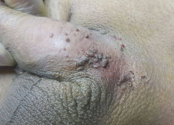  عکس زگیل تناسلی نوع ۱۸