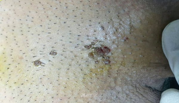  عکس زگیل تناسلی نوع ۱۸