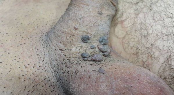  عکس زگیل تناسلی نوع ۱۸