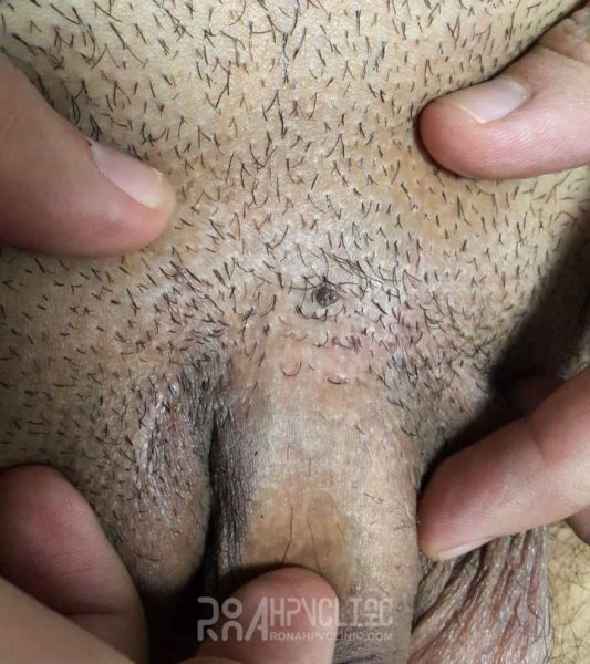  عکس زگیل تناسلی در زنان