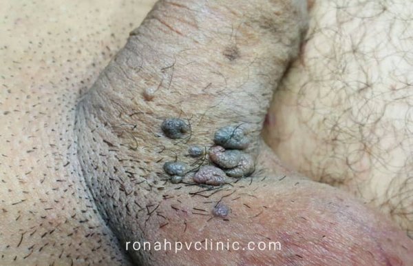 عکس زگیل تناسلی در زنان