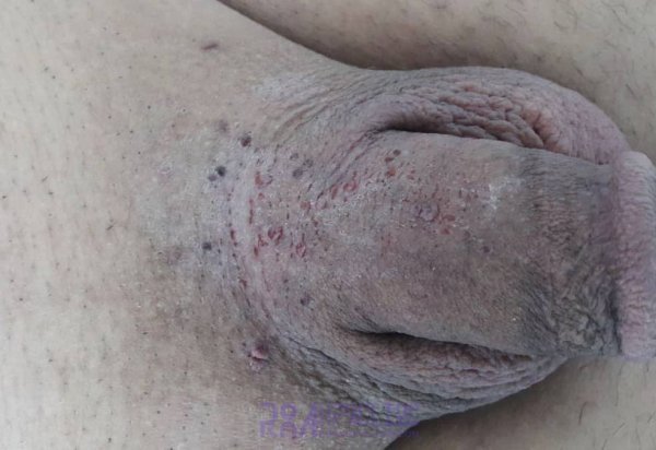 عکس زگیل تناسلی نوع ۱۶