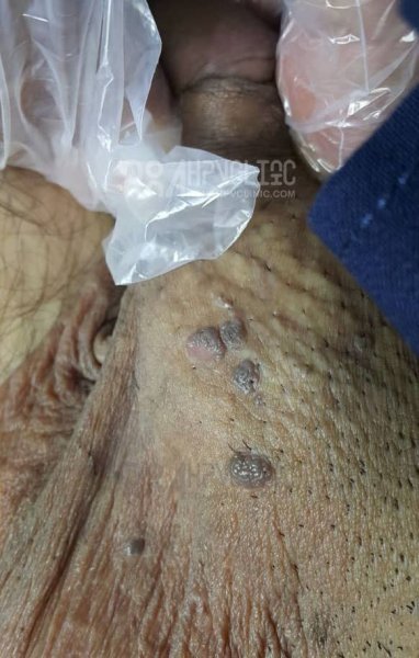 عکس زگیل تناسلی نوع ۱۶