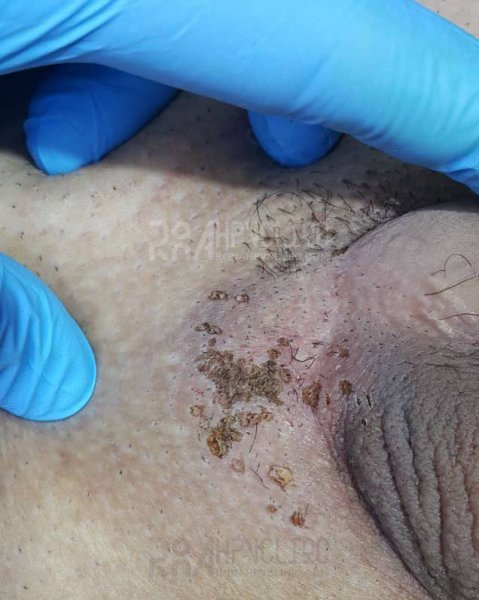  عکس زگیل سرطانی