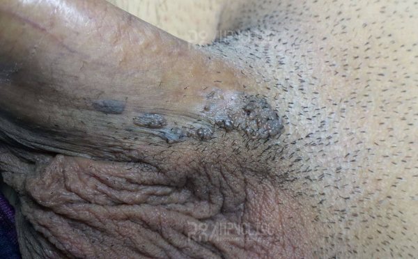  عکس زگیل سرطانی