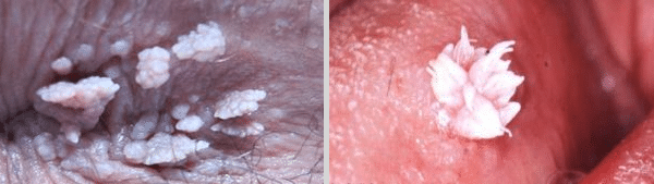  عکس زگیل سرطانی