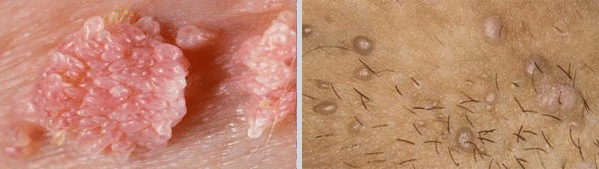  عکس زگیل سرطانی