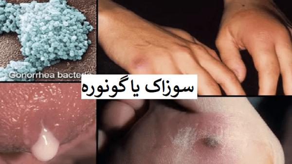  عکس زگیل سرطانی