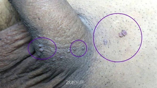  عکس زگیل سرطانی