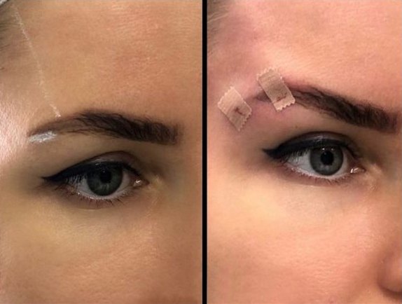  تصاویر عمل چشم گربه ای