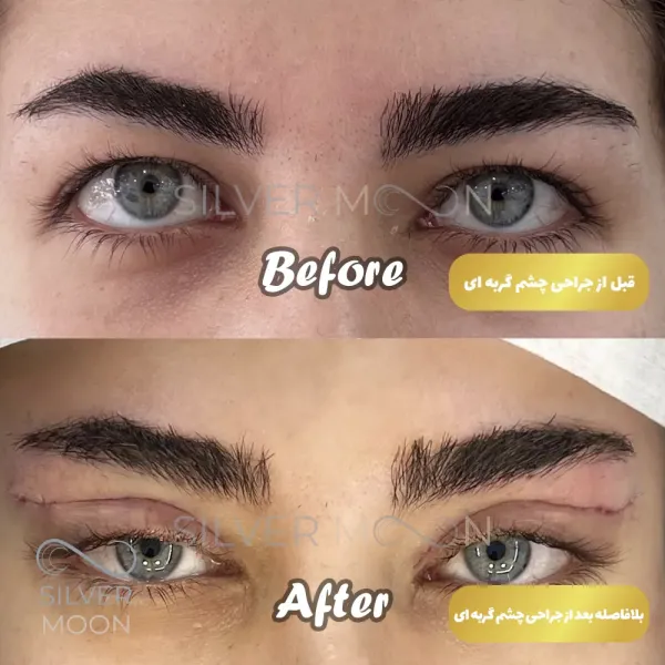  تصاویر عمل چشم گربه ای