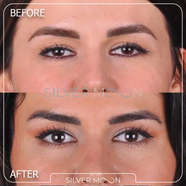  تصاویر عمل چشم گربه ای