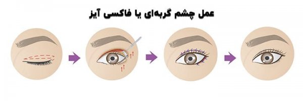  تصاویر عمل چشم گربه ای