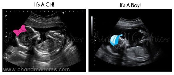  ایده عکس سونوگرافی دختر