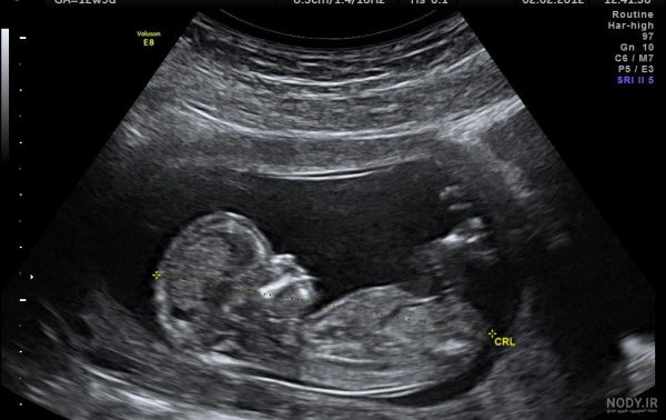  عکس سونوگرافی پسر