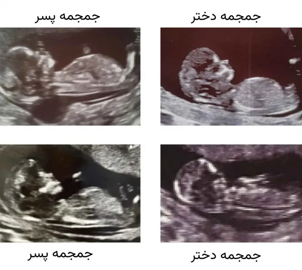  عکس سونوگرافی پسر